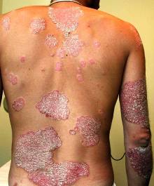 Eczema e i suoi sintomi e fotografia